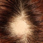 円形脱毛症の原因とその対処方法